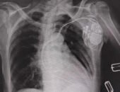 هيئة الرعاية الصحية: «إشراقة أمل» تروي قصة تعافي فتاة عانت منذ طفولتها من ضيق شديد بالصمام الرئوي بعد تدخل دقيق بالقسطرة بمستشفى النصر التخصصي ببورسعيد